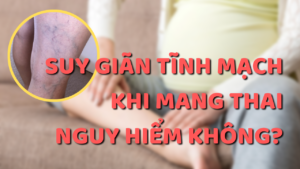 Suy giãn tĩnh mạch khi mang thai ảnh hưởng như thế nào tới mẹ bầu?